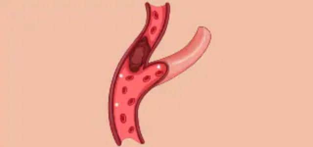 illustration of a clogged artery